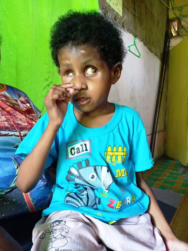 UP2KP: Seorang Anak di Supiori Terindikasi Menderita Rubella
