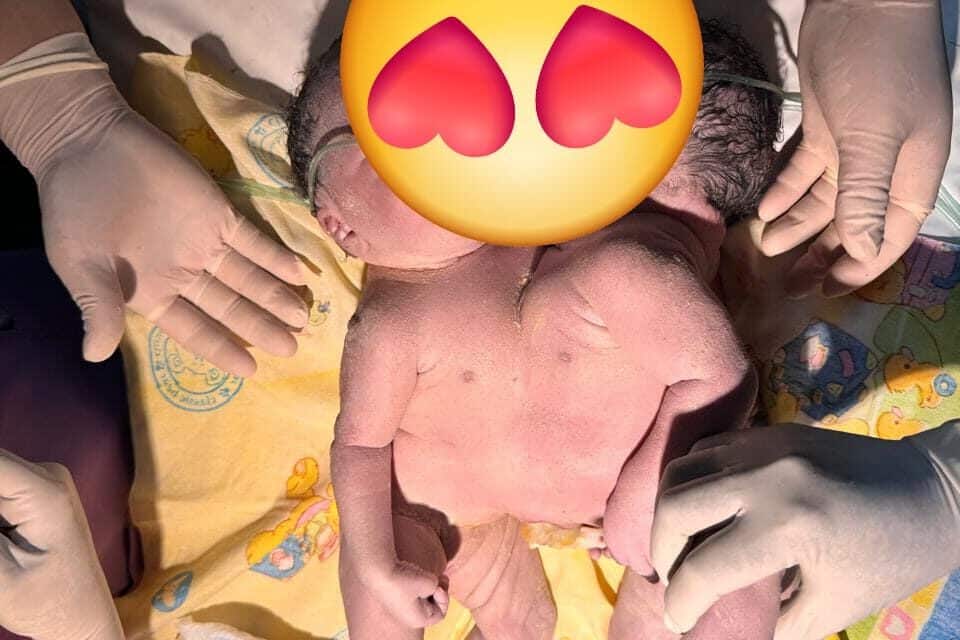 RSUD Jayapura Sukses Tangani Kelahiran Bayi Kembar Siam, Operasi Pemisahan Menunggu Hasil Pemeriksaan
